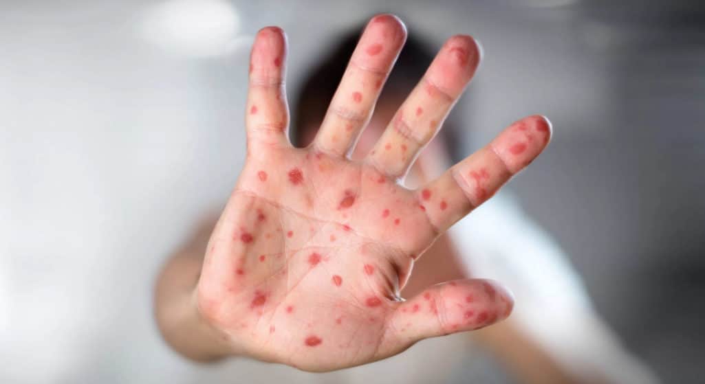 Τα κρούσματα της ιλαράς στον κόσμο σχεδόν τριπλασιάσθηκαν από τον Ιανουάριο σε σχέση με την ίδια περίοδο πέρυσι, όπως ανακοίνωσε ο Παγκόσμιος Οργανισμός Υγείας (ΠΟΥ).